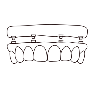 denture on implants
