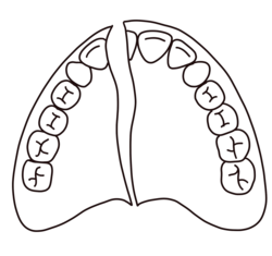 denture on implants